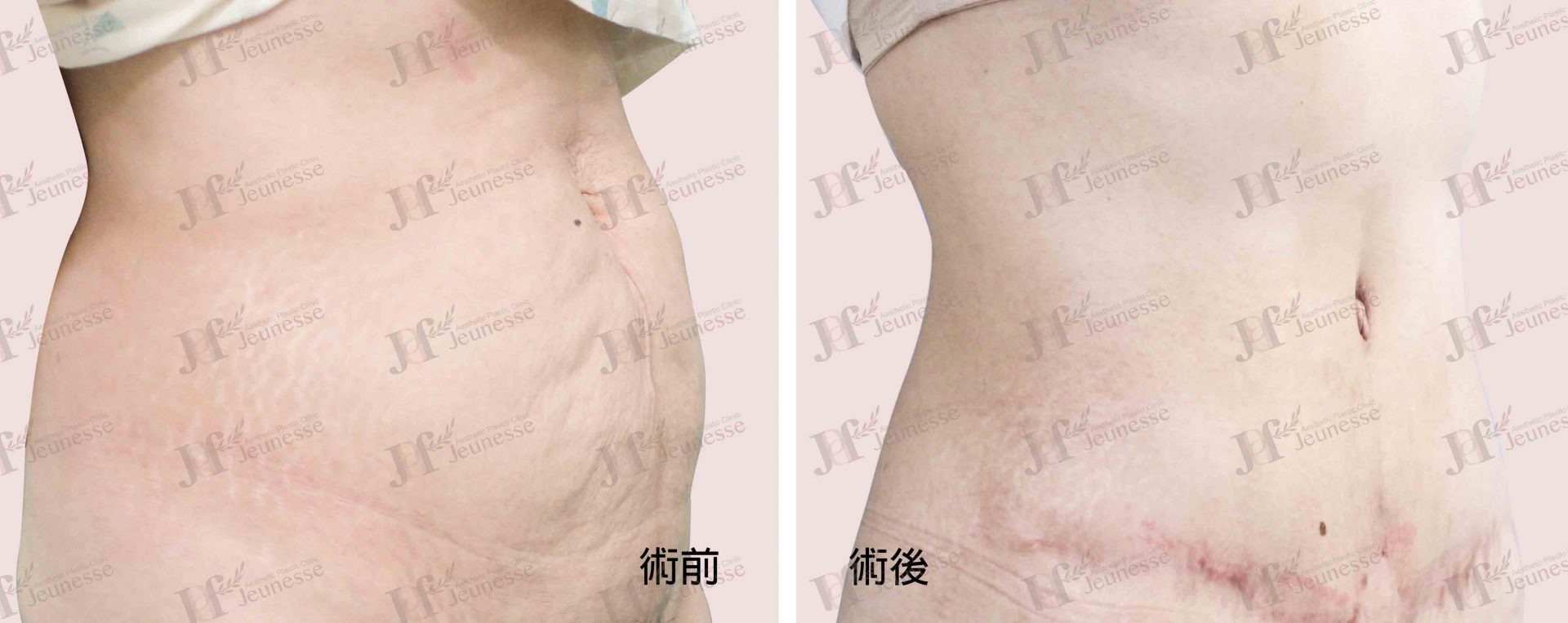 Abdominoplasty腹部成形術及抽脂手術 case 1 45度-浮水印