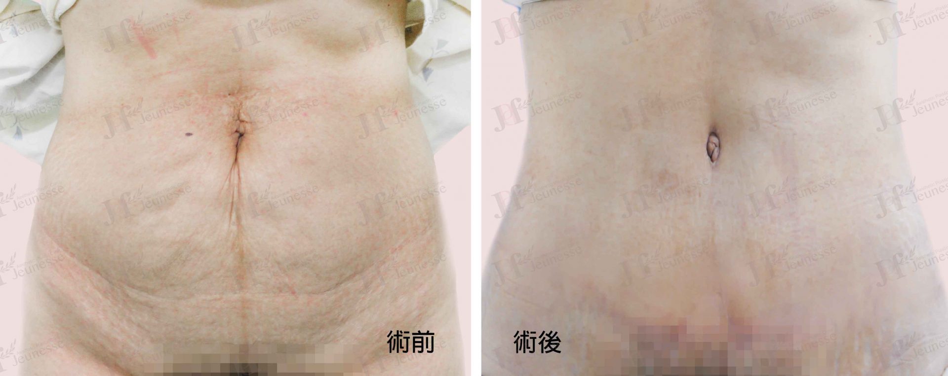Abdominoplasty腹部成形術及抽脂手術 case 1 正面-浮水印