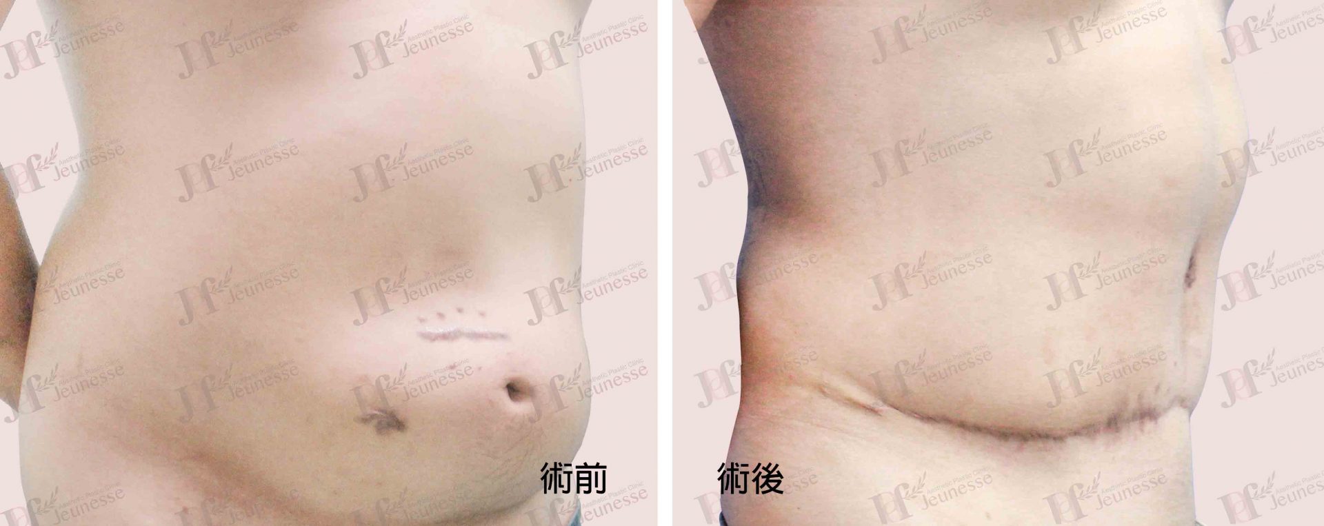 Abdominoplasty腹部成形術及抽脂手術 case 2 45度-浮水印
