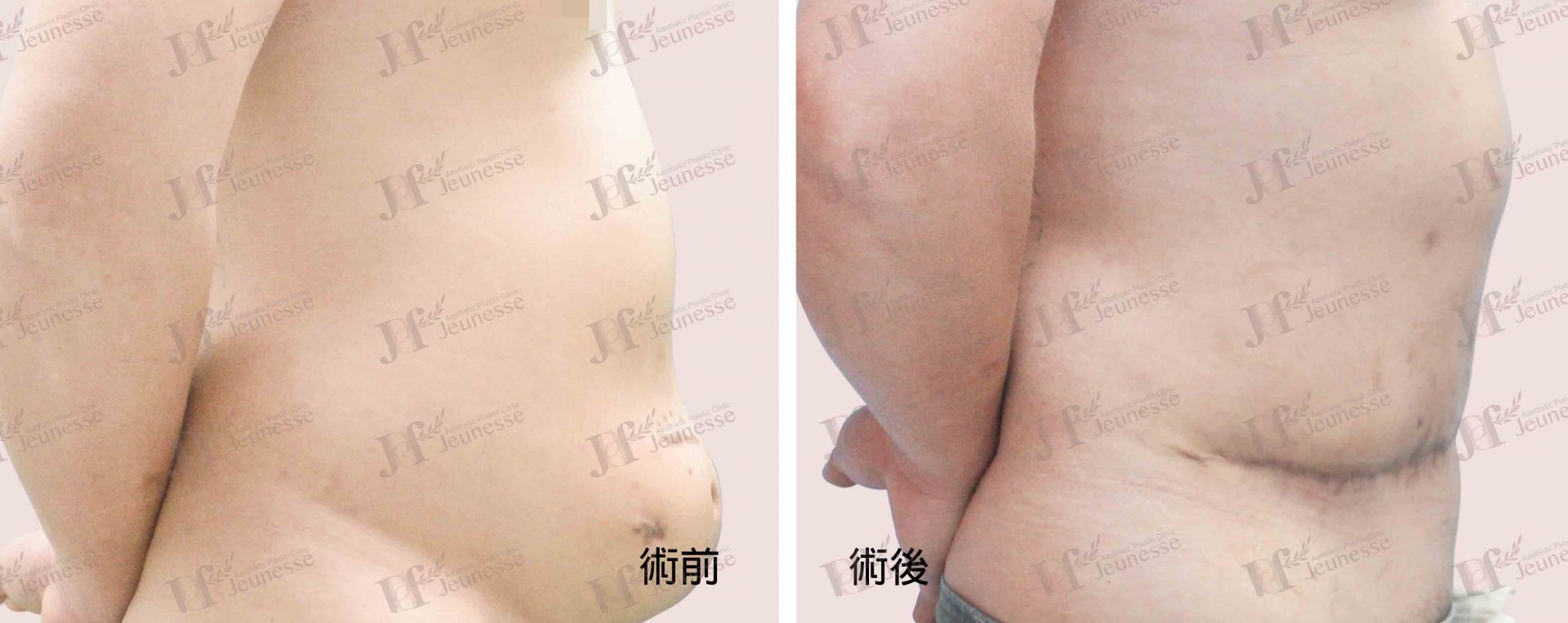 Abdominoplasty腹部成形術及抽脂手術 case 2 側面-浮水印