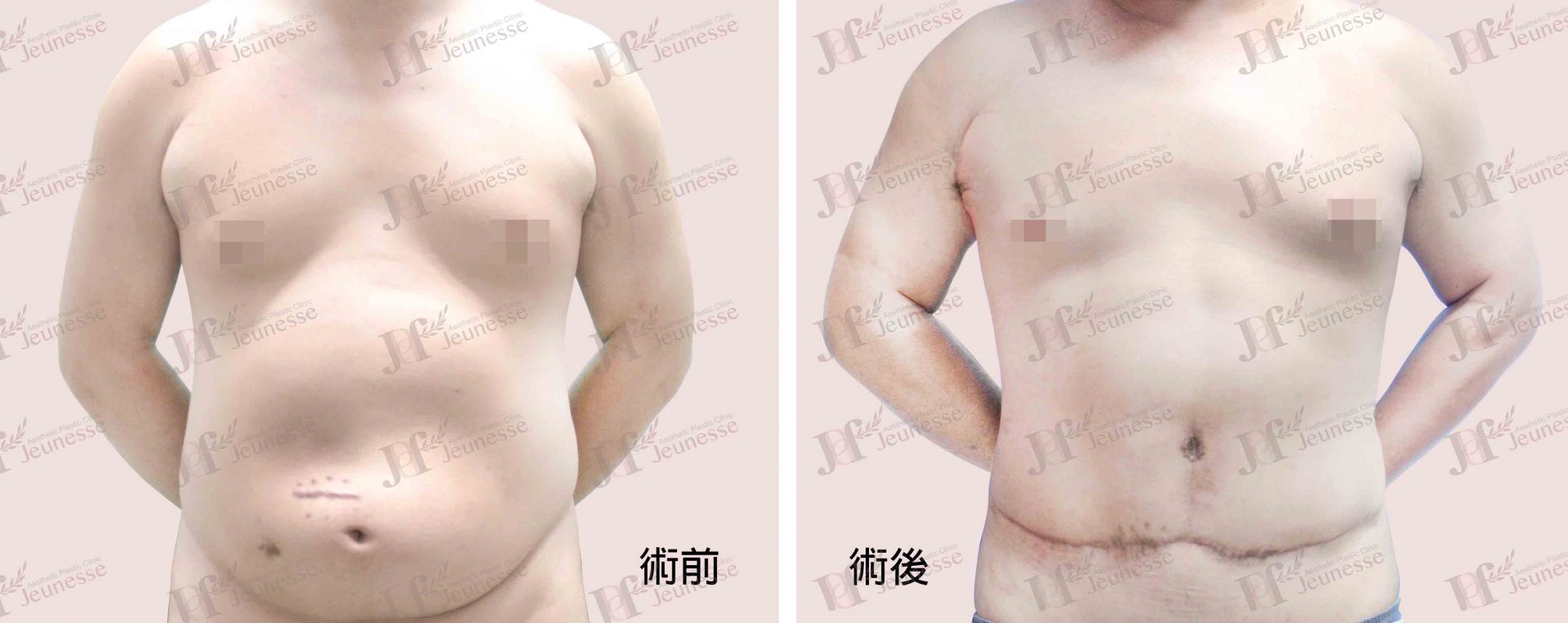 Abdominoplasty腹部成形術及抽脂手術 case 2 正面-浮水印