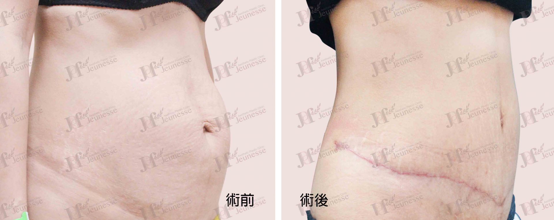 Abdominoplasty腹部成形術及抽脂手術 case 5 45度-浮水印