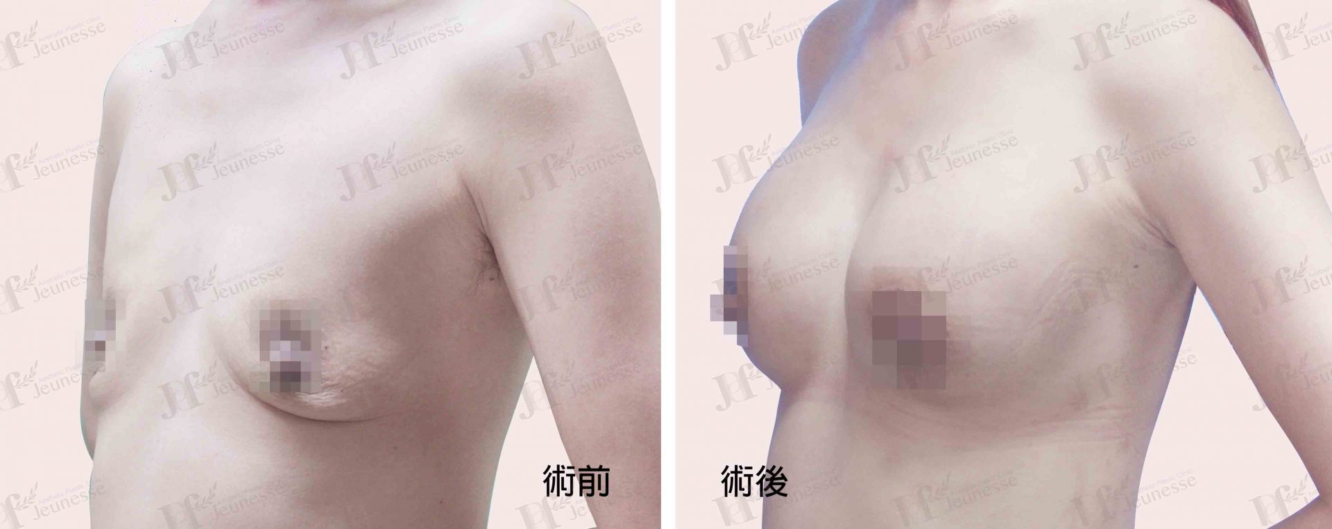 Breast Augmentation- Silicone implants -case2 45度-浮水印