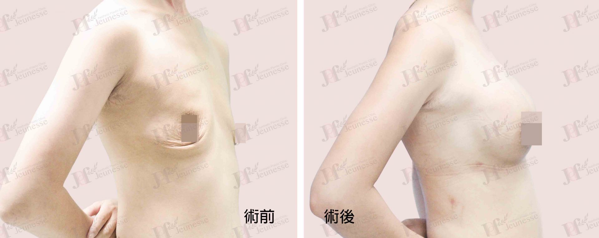 Breast Augmentation- Silicone implants -case2 側面-浮水印