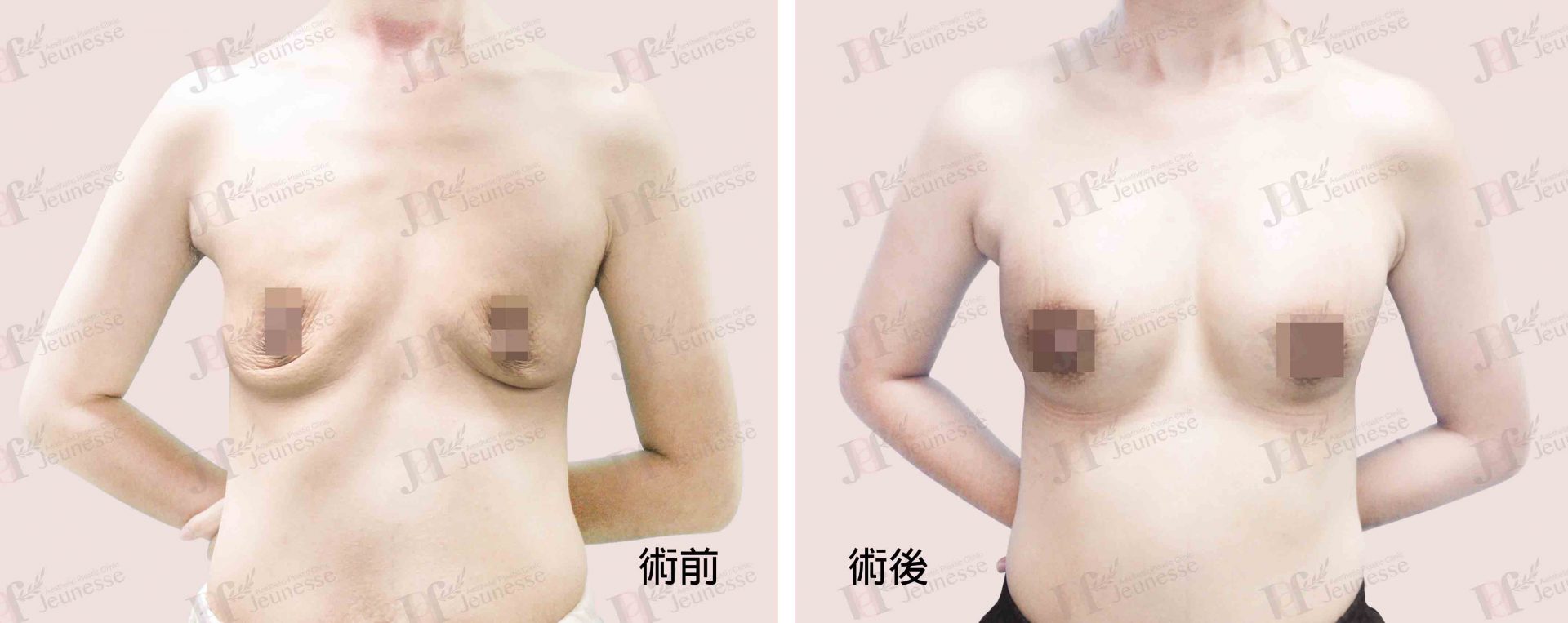 Breast Augmentation- Silicone implants -case2 正面-浮水印