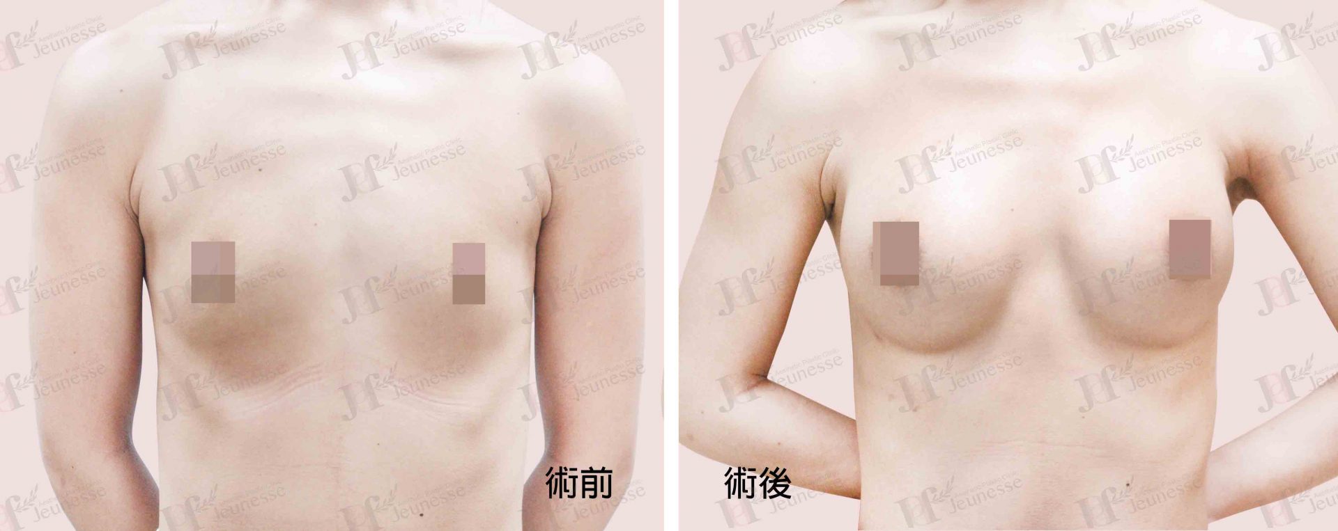Breast Augmentation- Silicone implants -case3 正面-浮水印