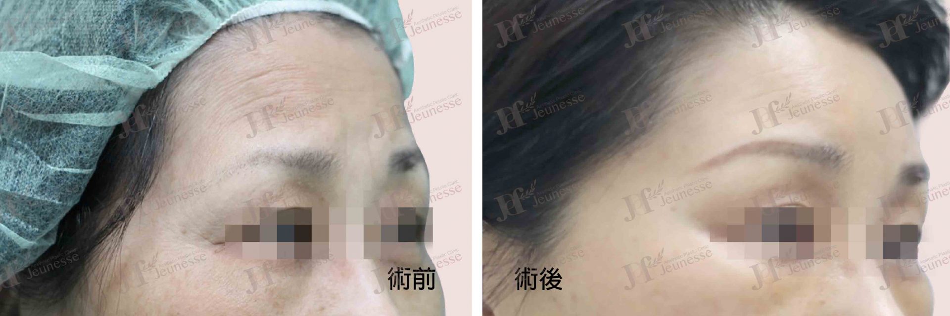 Forehead lifting case 2 45度-浮水印