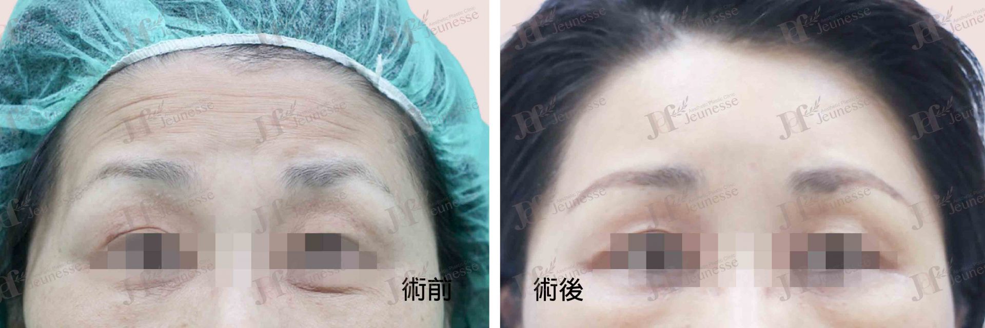 Forehead lifting case 2 正面-浮水印
