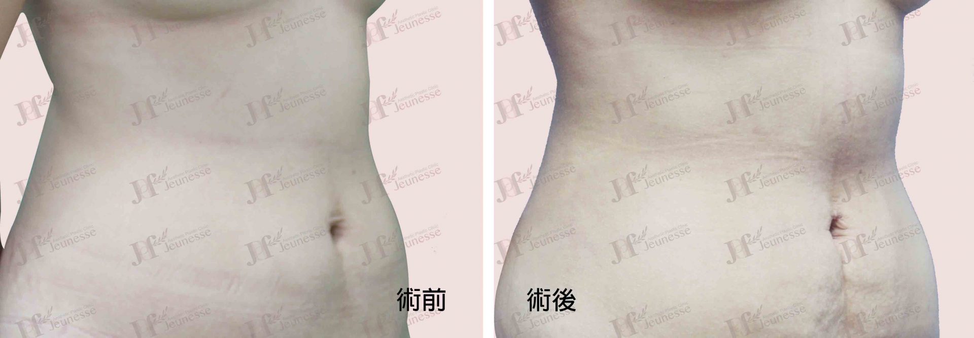 Liposuction- Abdomen case2 45度-浮水印