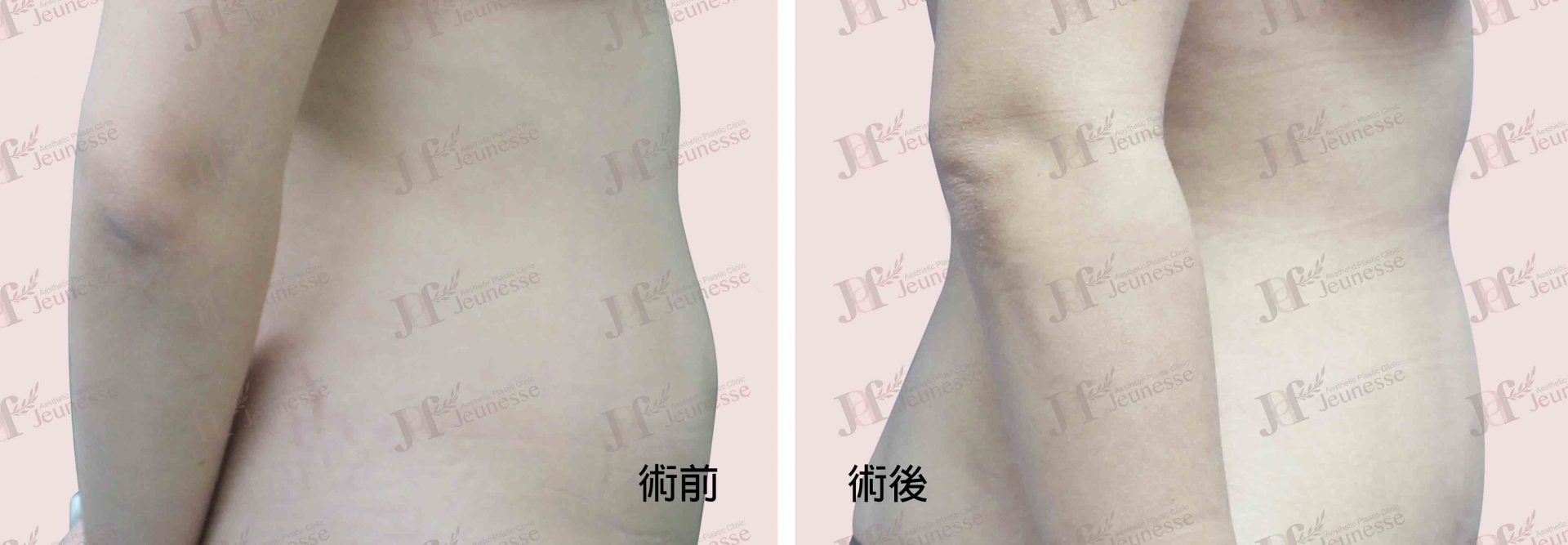 Liposuction- Abdomen case2 側面-浮水印