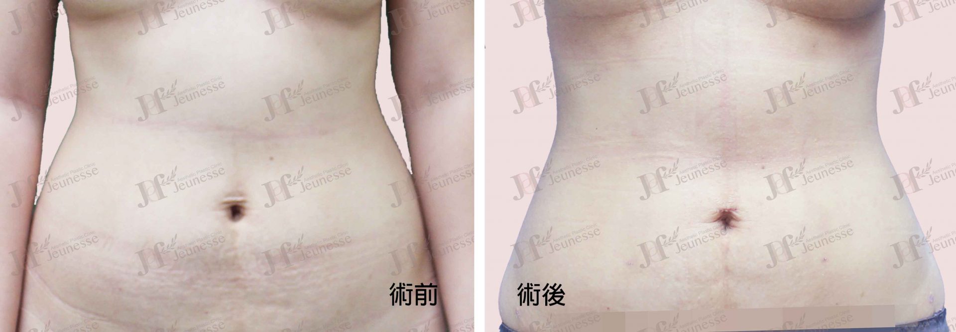 Liposuction- Abdomen case2 正面-浮水印