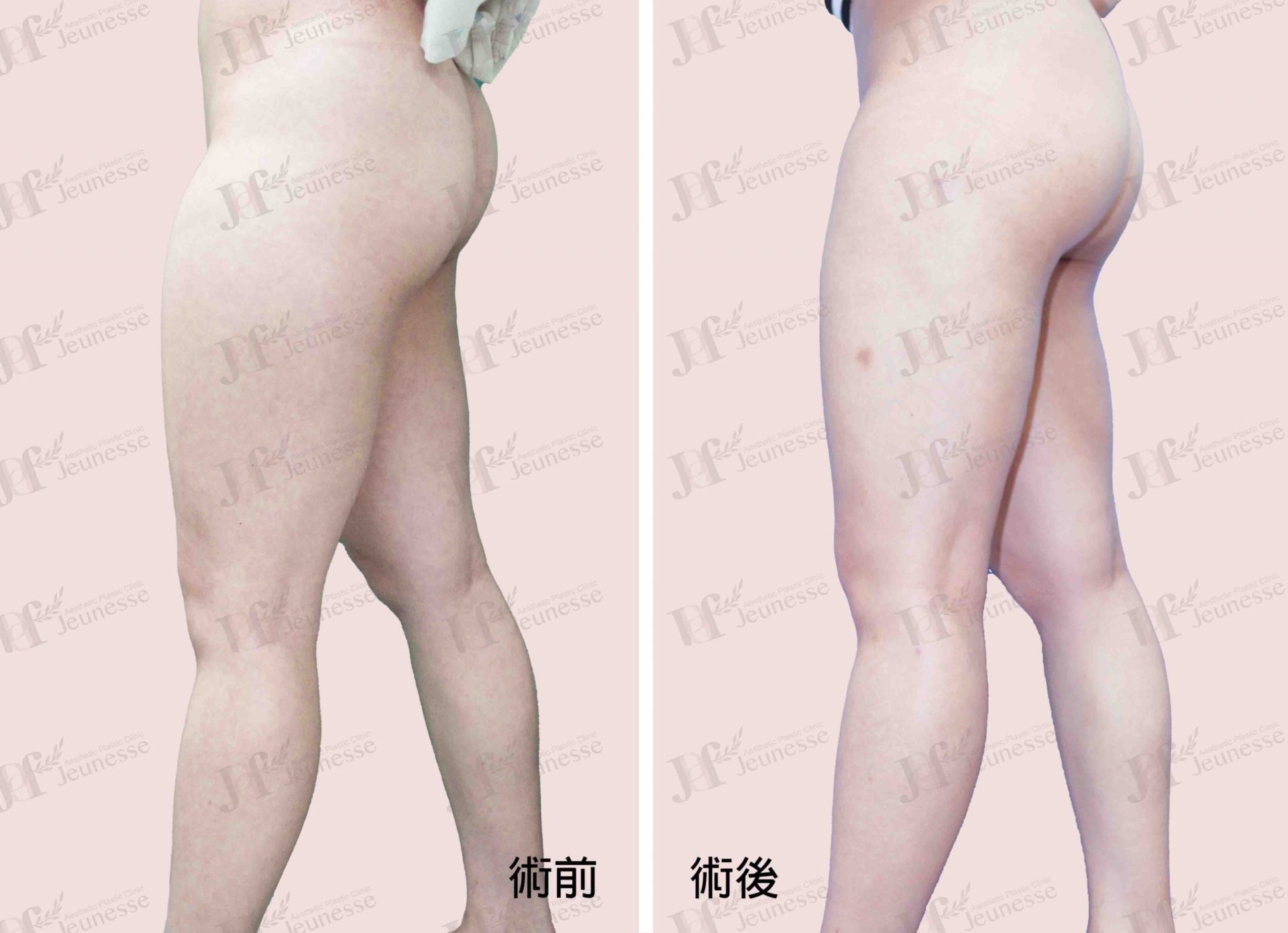 Liposuction- Thighs case2 側面-浮水印