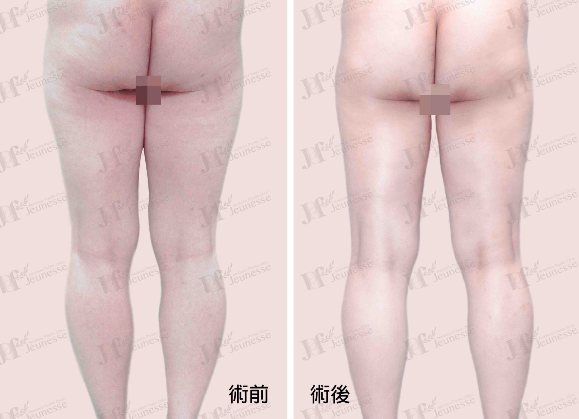 Liposuction- Thighs case2 背面-浮水印