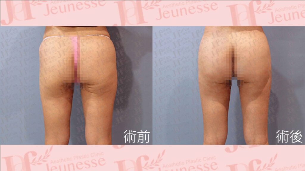 超能電漿＋LSSA抽脂(大腿後側)＋自體脂肪移植(臀部)