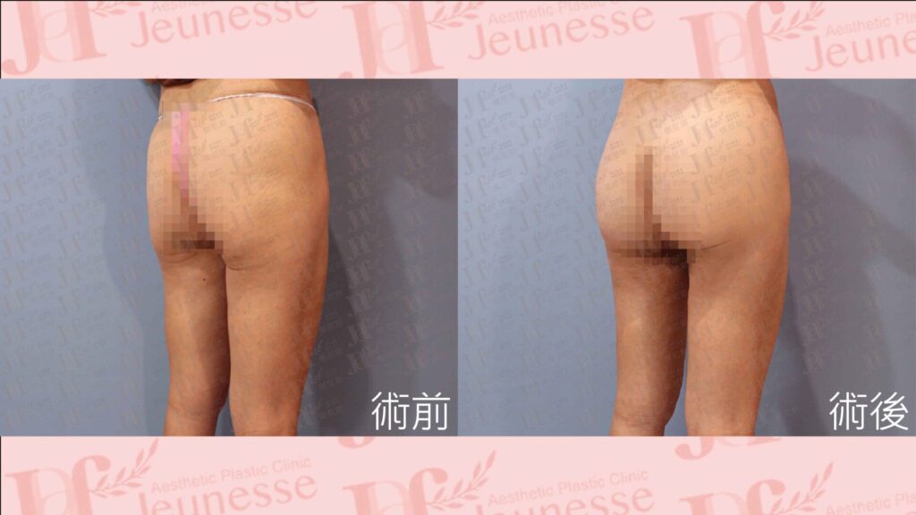 超能電漿＋LSSA抽脂(大腿環抽)＋自體脂肪移植(臀部)
