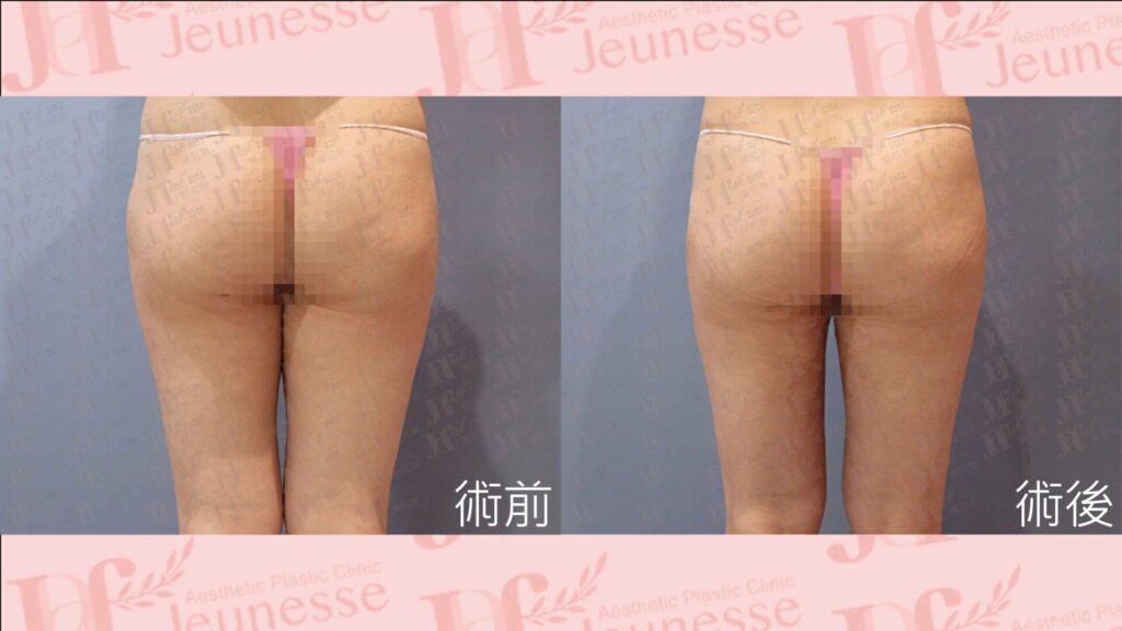 超能電漿＋LSSA抽脂(大腿環抽)＋自體脂肪移植(臀部)