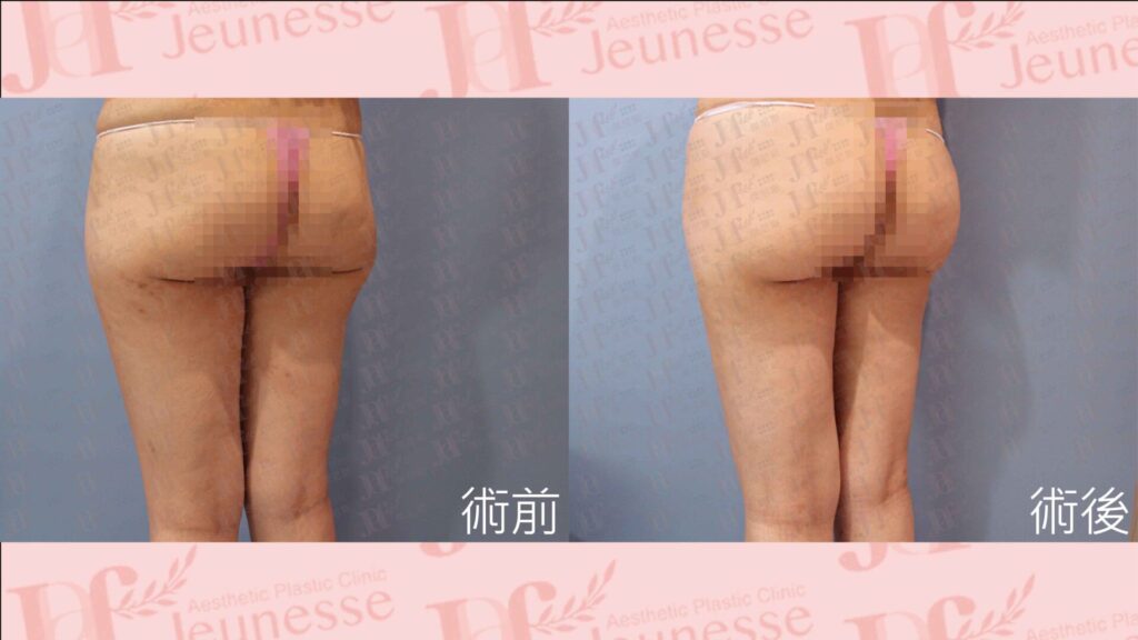 超能電漿＋LSSA抽脂(後腿部)＋自體脂肪移植(臀部)