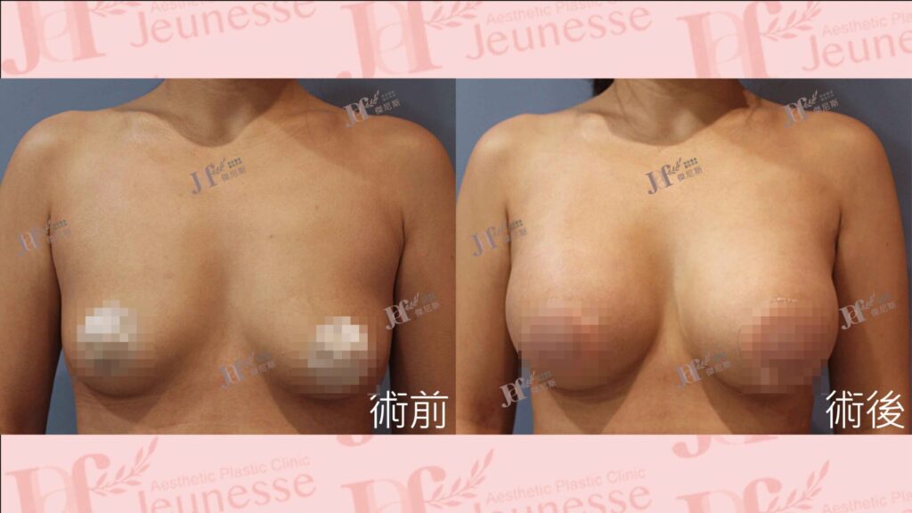珍珠波隆乳手術