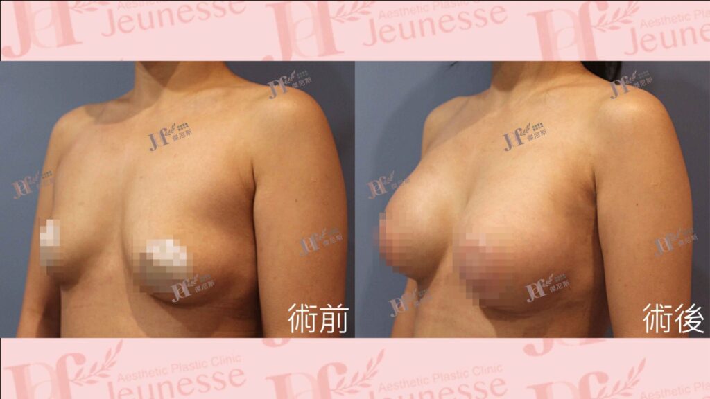 珍珠波隆乳手術