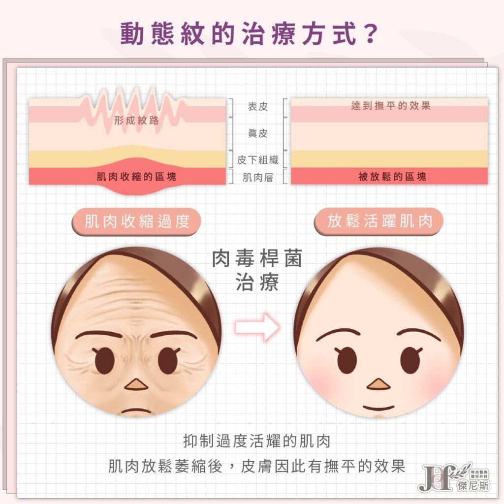 臉部年輕化-動態紋(肉毒)_3_0