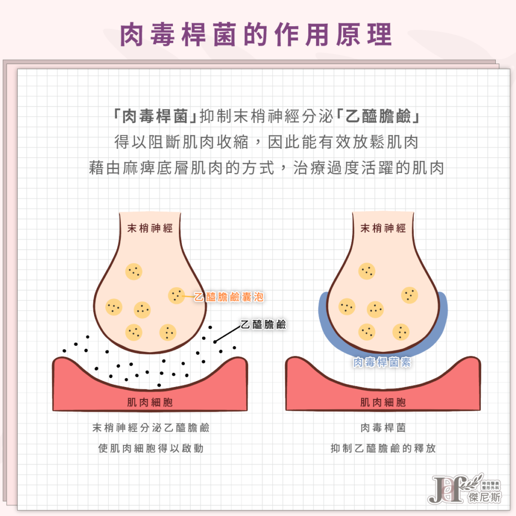 臉部年輕化-動態紋(肉毒)_4_0