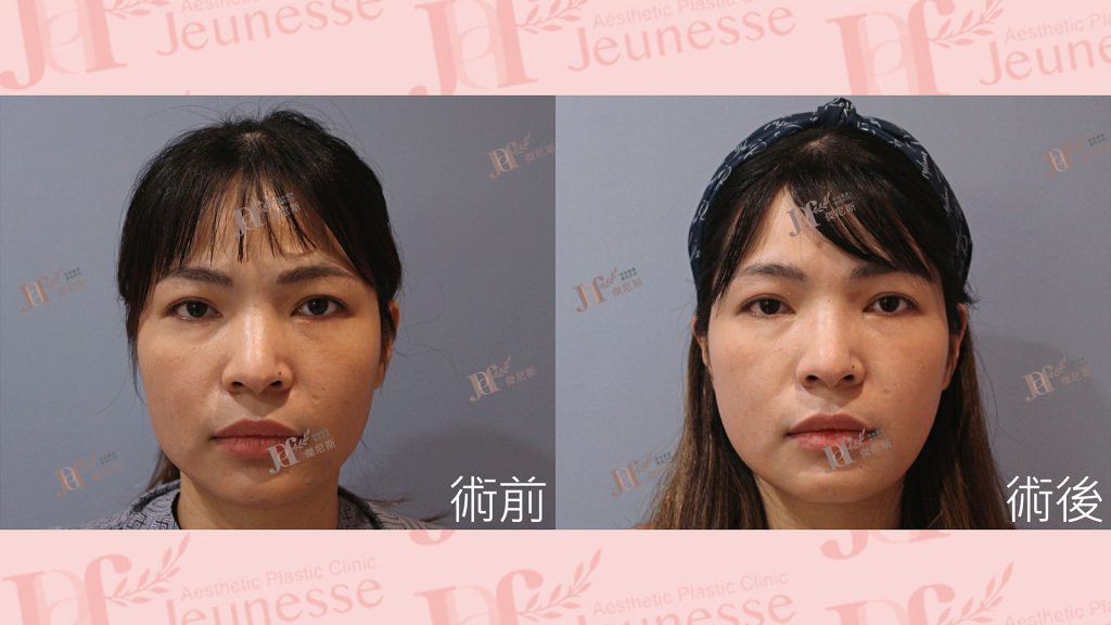 下顎骨削骨手術