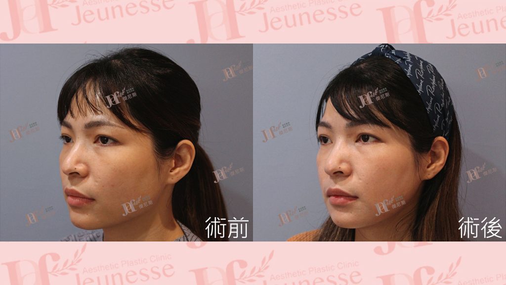 下顎骨削骨手術