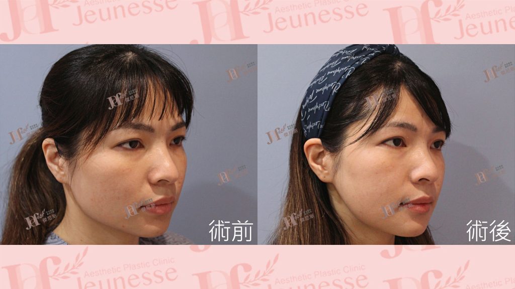 下顎骨削骨手術