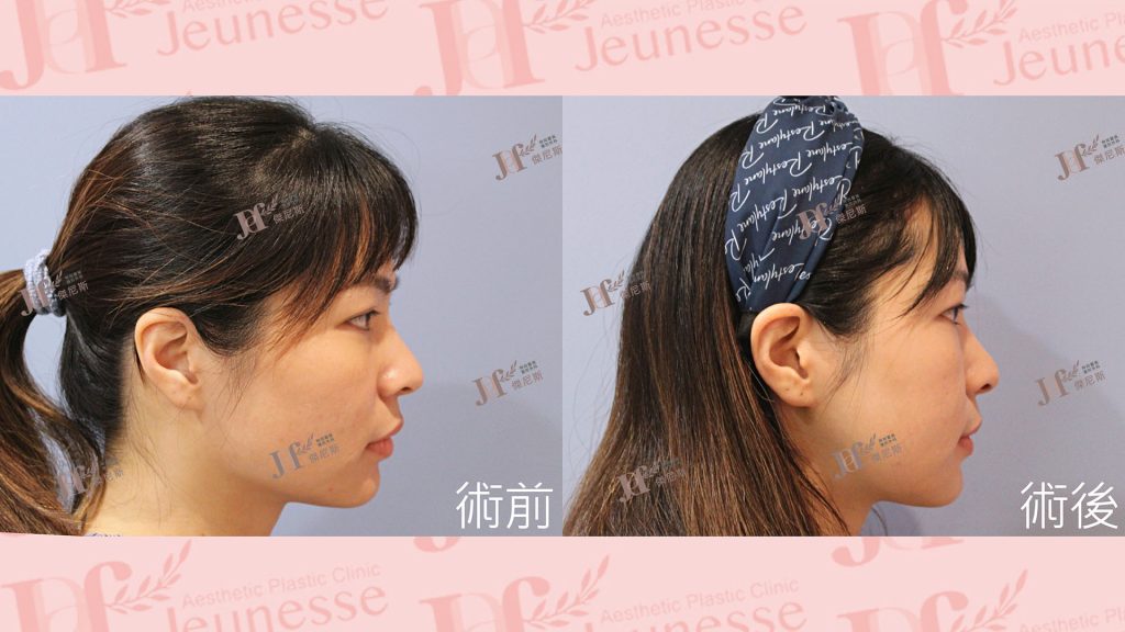 下顎骨削骨手術