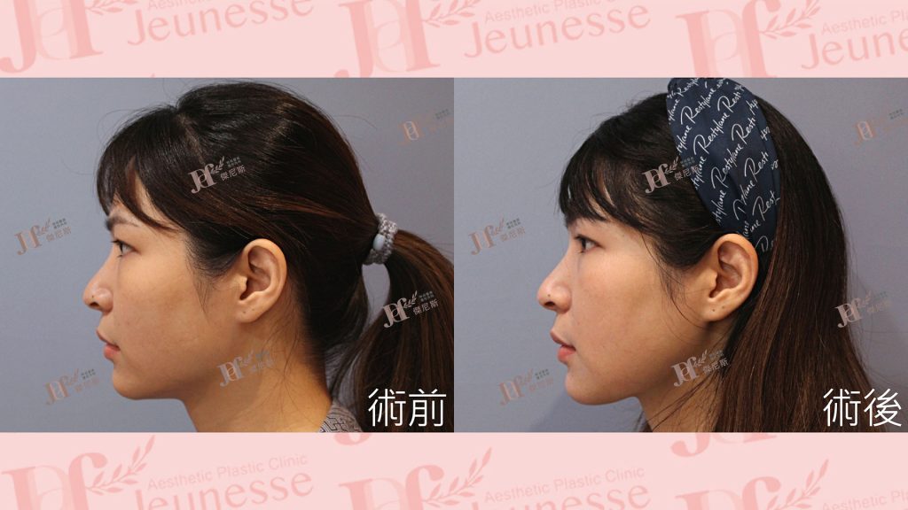 下顎骨削骨手術