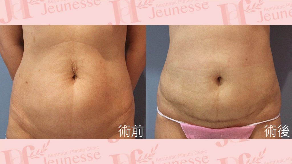 腹部成形術(超能電漿Z+超音波抽脂)