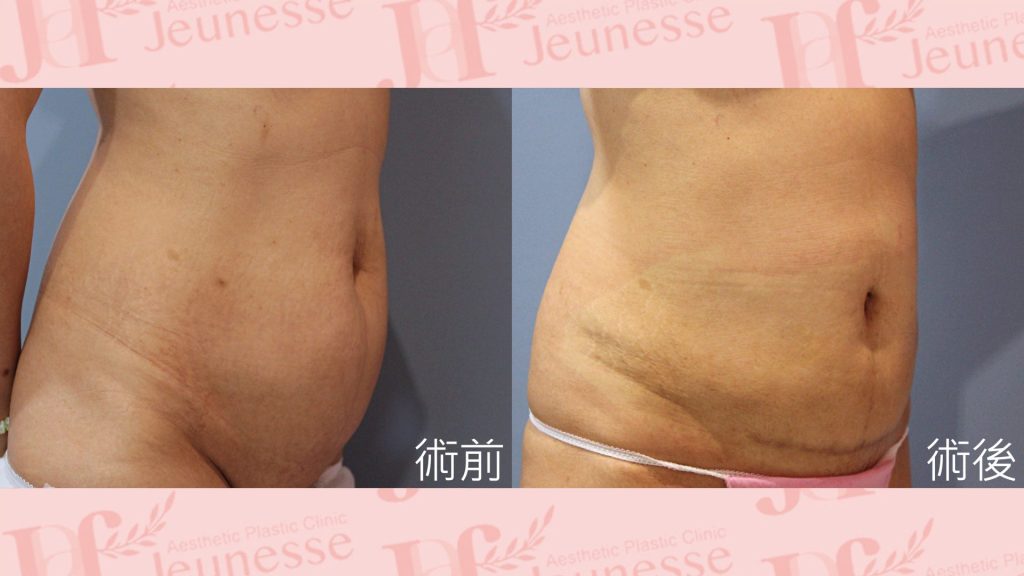 腹部成形術(超能電漿Z+超音波抽脂)