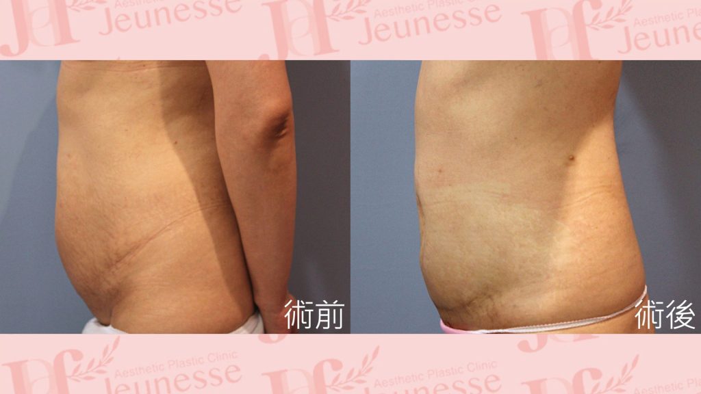 腹部成形術(超能電漿Z+超音波抽脂)