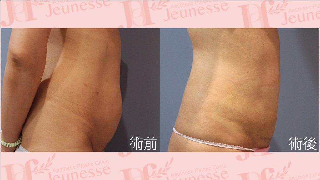 腹部成形術(超能電漿Z+超音波抽脂)