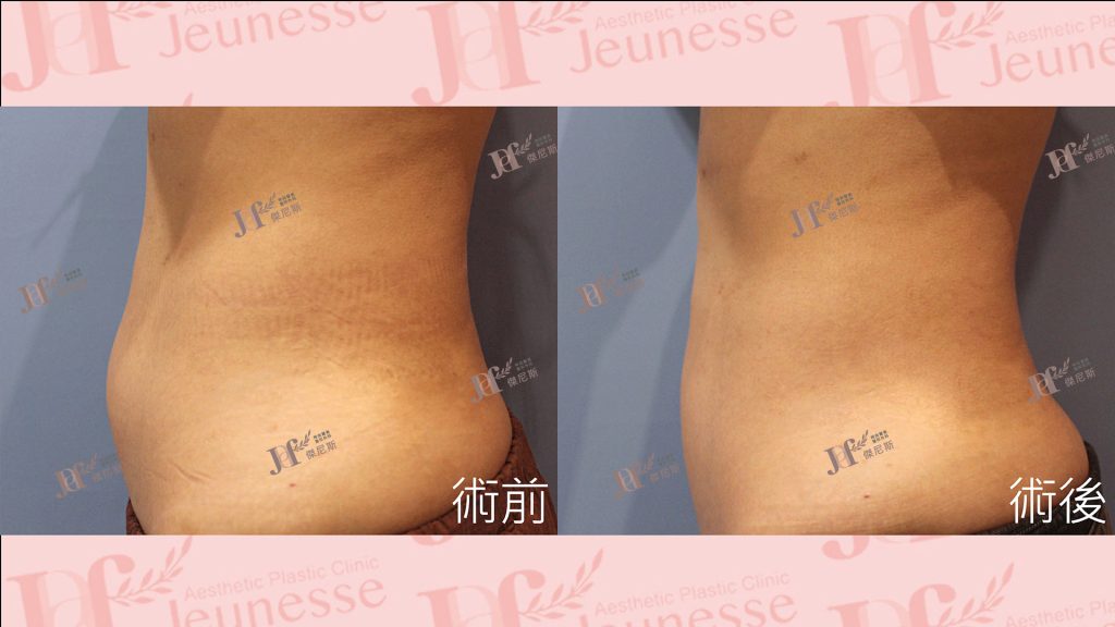 超音波抽脂(腹部)