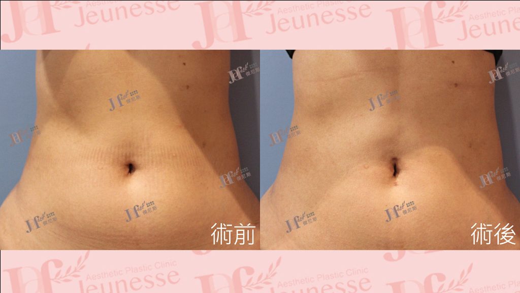 超音波抽脂(腹部)