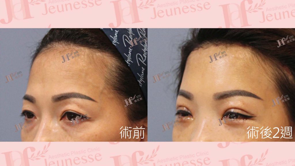 內視鏡前額七爪釘＋雙眼皮＋內開眼袋＋自體脂肪移植(淚溝)