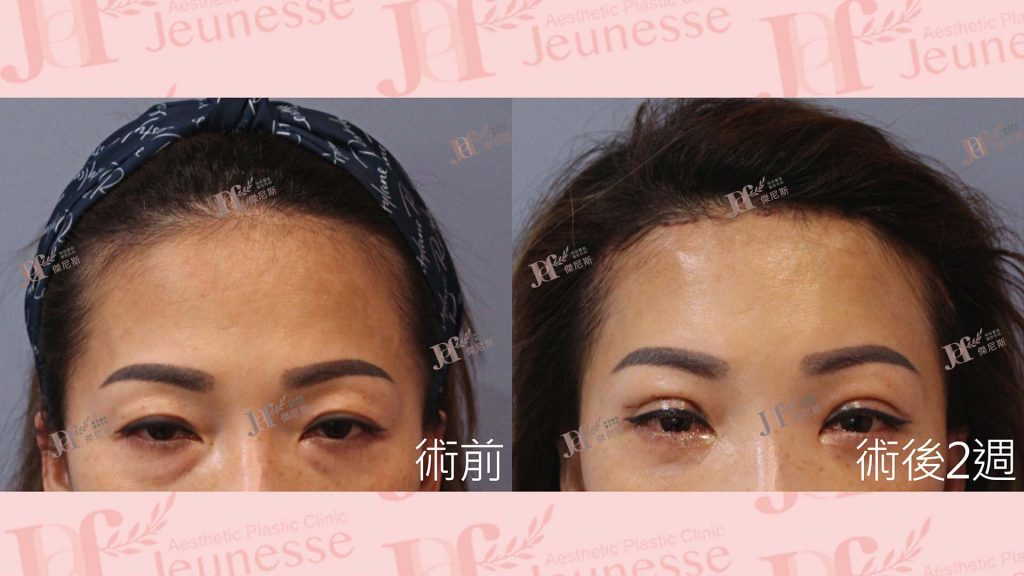 內視鏡前額七爪釘＋雙眼皮＋內開眼袋＋自體脂肪移植(淚溝)