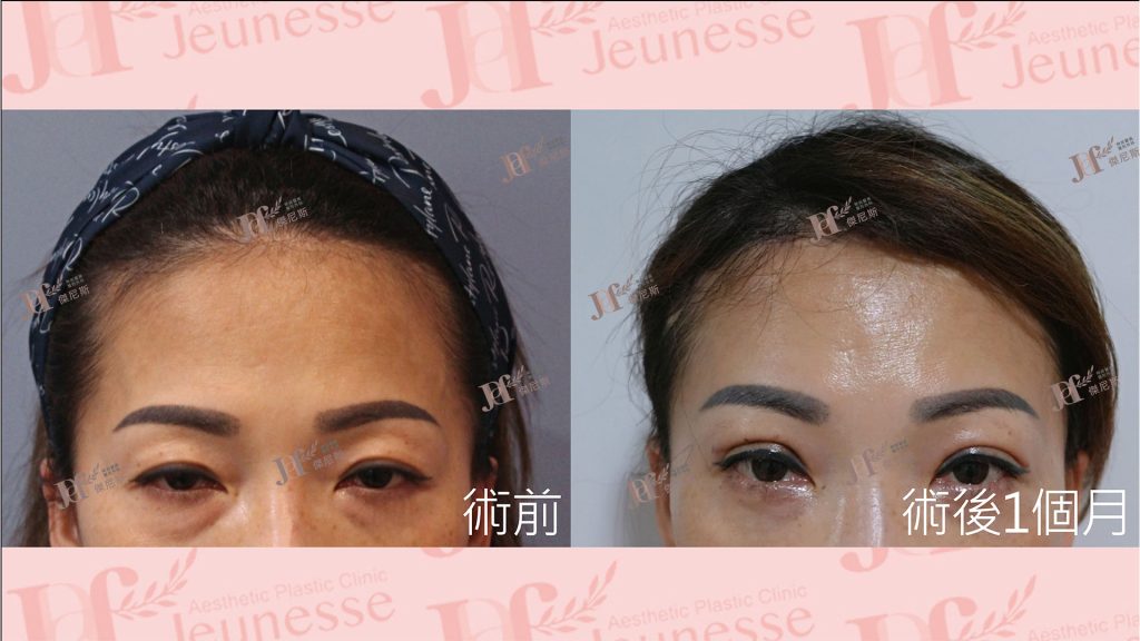 內視鏡前額七爪釘＋雙眼皮＋內開眼袋＋自體脂肪移植(淚溝)