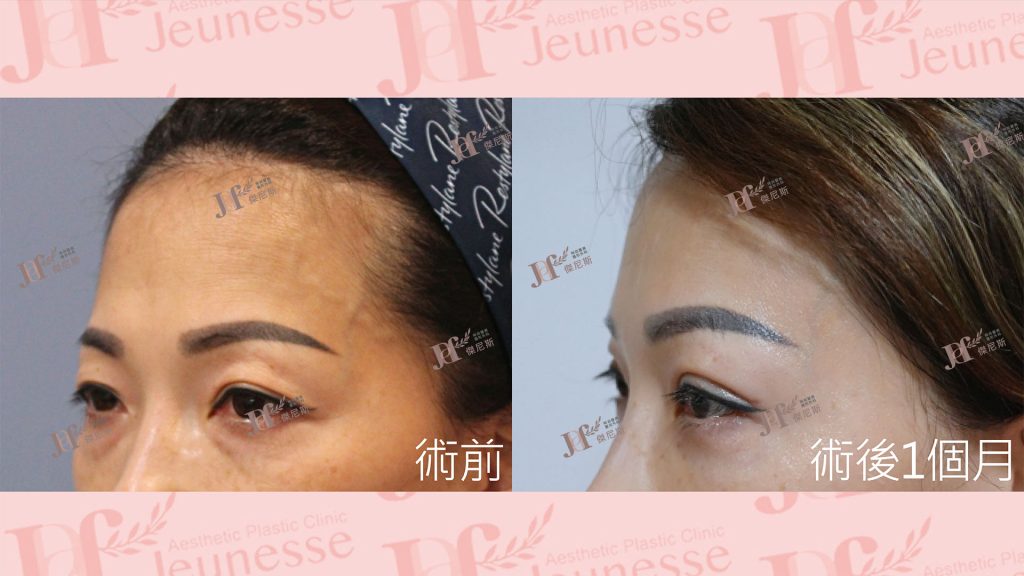 內視鏡前額七爪釘＋雙眼皮＋內開眼袋＋自體脂肪移植(淚溝)