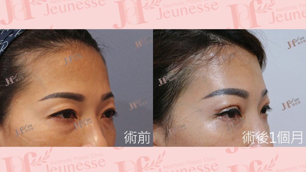 內視鏡前額七爪釘＋雙眼皮＋內開眼袋＋自體脂肪移植(淚溝)