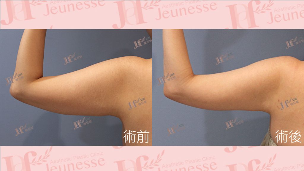 超音波抽脂＋超能電漿(手臂)_0810224-01_工作區域 1