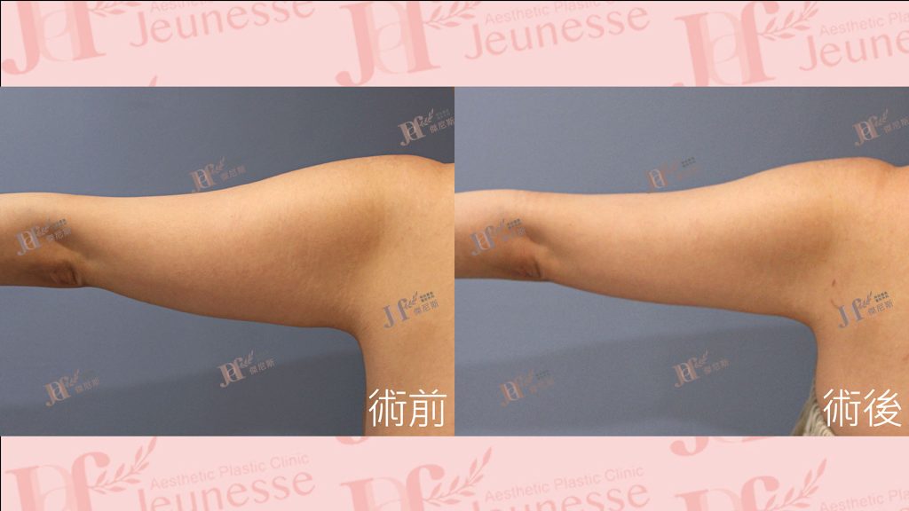 超能電漿Z+超音波抽脂(手臂)