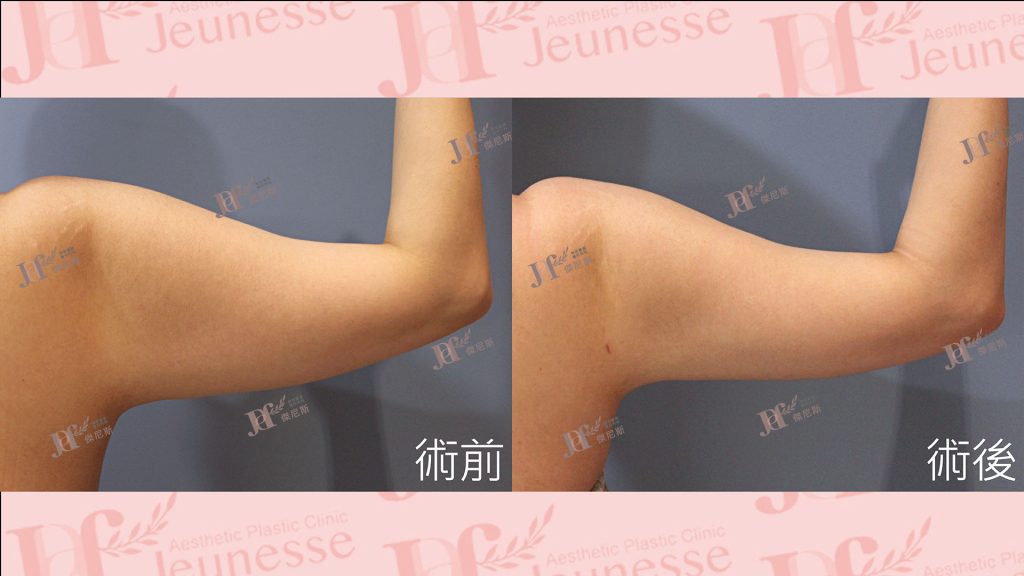 超能電漿Z+超音波抽脂(手臂)