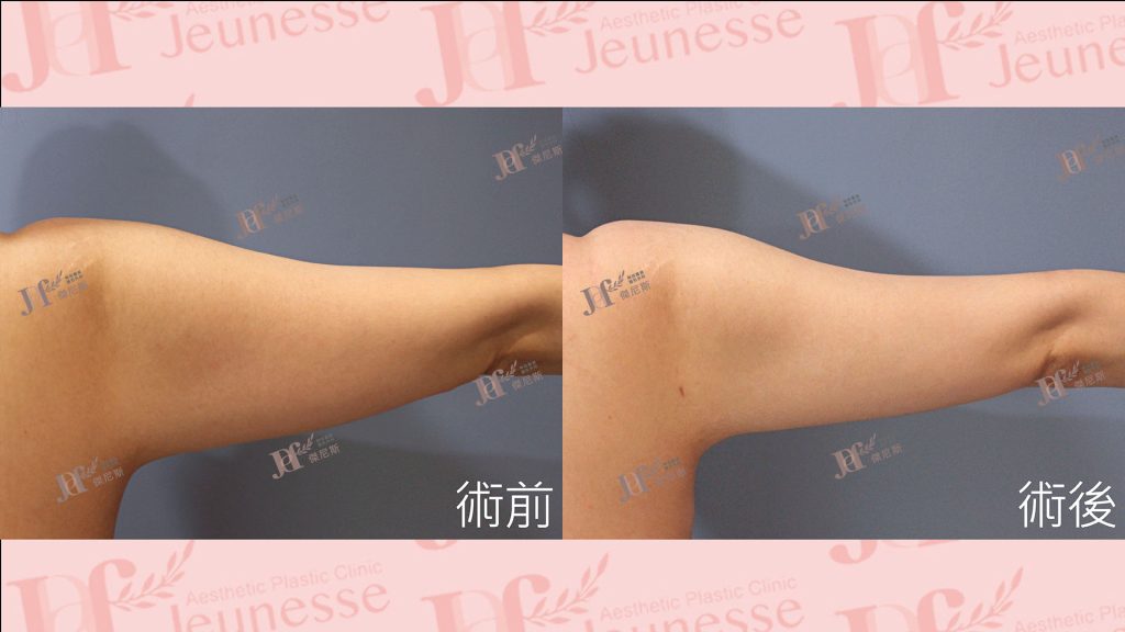 超能電漿Z+超音波抽脂(手臂)