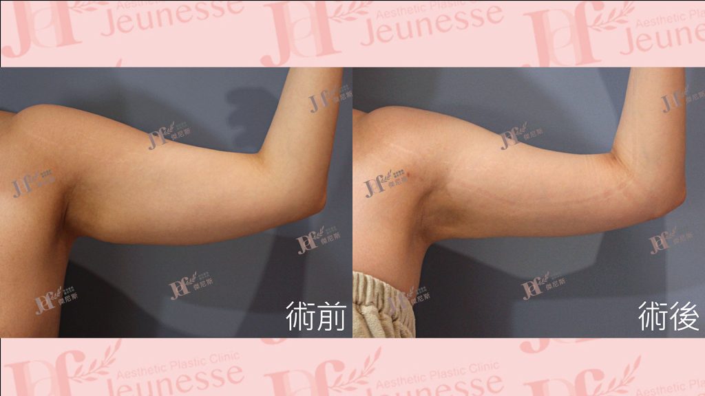 超能電漿Z+超音波抽脂(手臂)