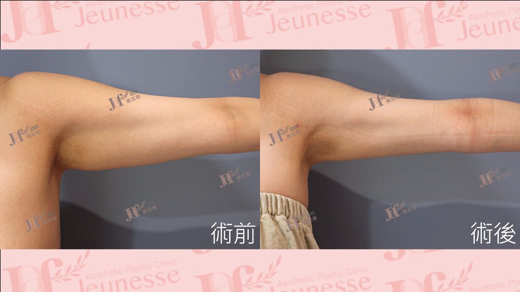 超能電漿Z+超音波抽脂(手臂)