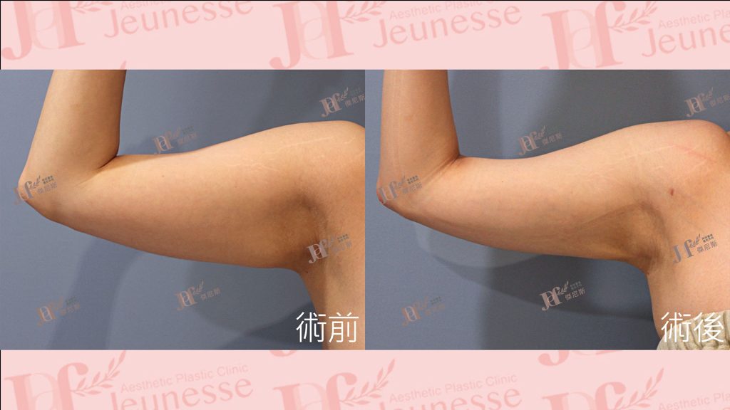 超能電漿Z+超音波抽脂(手臂)