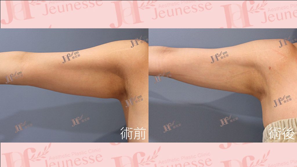 超能電漿Z+超音波抽脂(手臂)