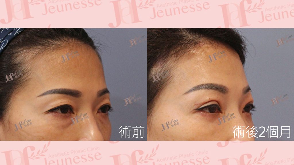 內視鏡前額七爪釘＋雙眼皮＋內開眼袋＋自體脂肪移植(淚溝)